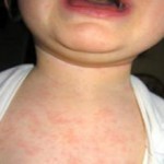 Детская розеола: симптомы и лечение
