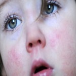 Скарлатина у детей:  симптомы и лечение