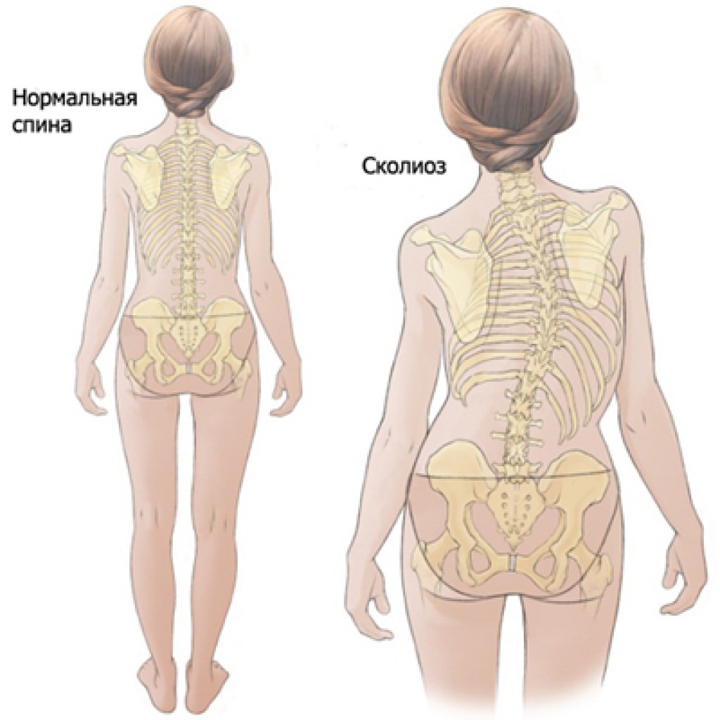 Позвоночник при сколиозе картинка