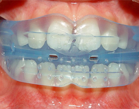 Ортодонтические трейнеры