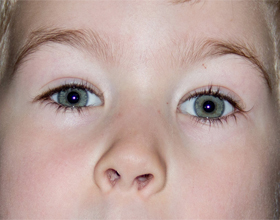 Лазерная коррекция зрения ребенку