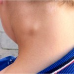 У ребенка увеличены лимфоузлы на шее: причины и лечение