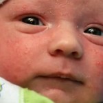 Акне у новорожденных – что это такое и нужно ли его лечить