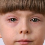 Блефарит у детей — лечение и особенности