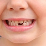 Флюс молочных зубов у детей