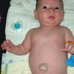 Пупочная грыжа у новорожденных: симптомы, лечение и профилактика