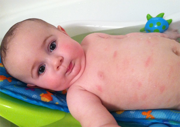 Атопический дерматит у малыша