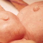 Паховая грыжа у грудничка.Симптомы и лечение грыжи