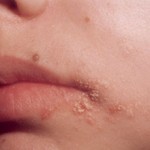 Бактериальная инфекция у детей: симптомы и лечение