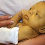 Желтуха у новорожденных: причины, лечение и последствия