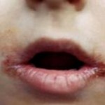 Почему у ребенка трескаются губы?