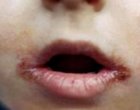 Почему у ребенка трескаются губы