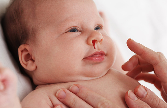 Кровь из носа у малыша