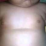 Впалая грудная клетка у ребенка: причины, лечение, фото