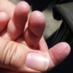 У ребенка облазит кожа на пальцах рук (ног): причины и что делать